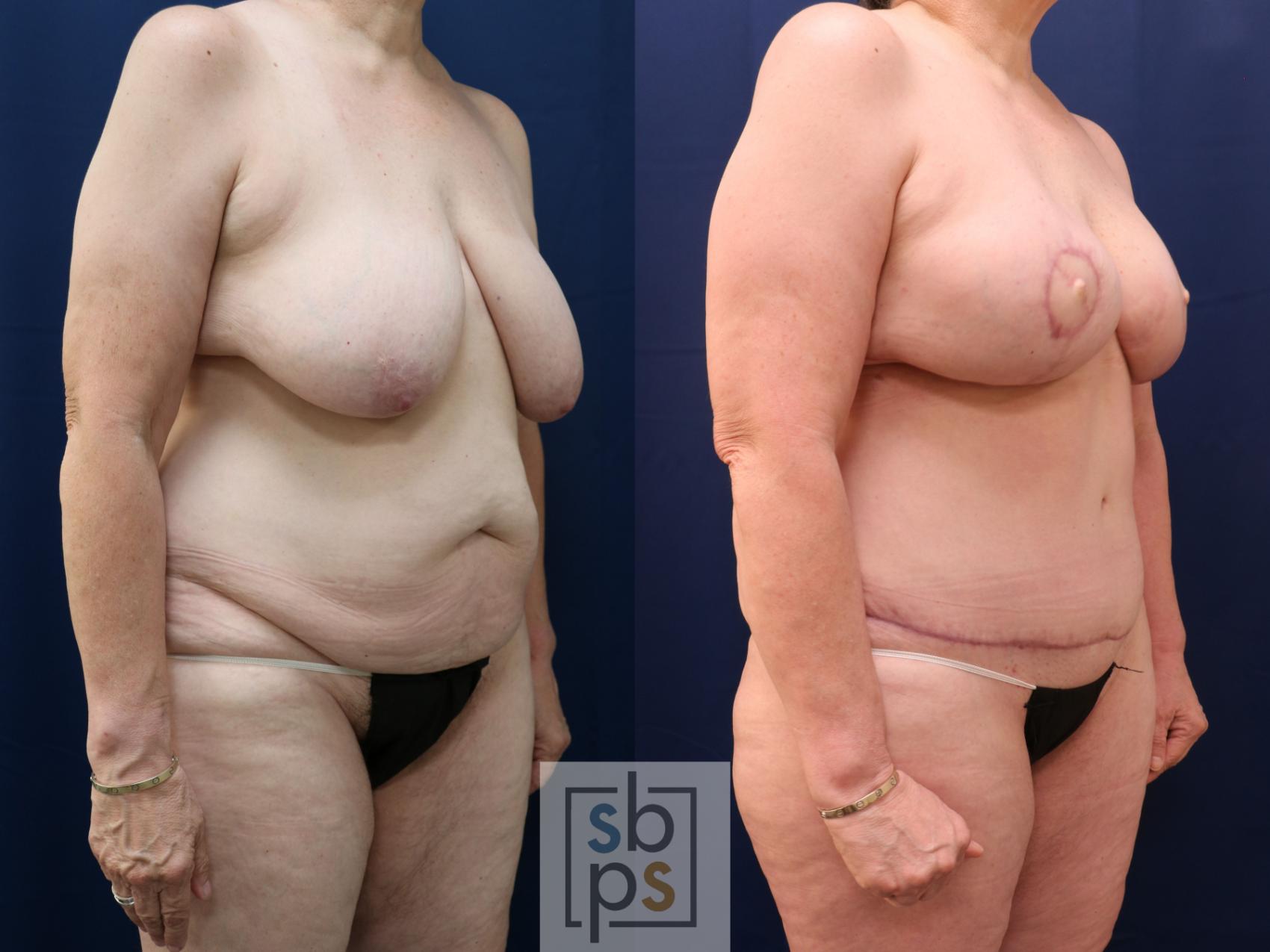 Before & After Breast Reconstruction Case 773 Right Oblique View in Los Angeles, Torrance & Long Beach, CA