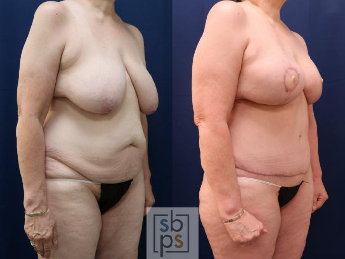 Before & After Breast Reconstruction Case 773 Right Oblique View in Los Angeles, Torrance & Long Beach, CA
