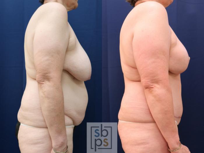 Before & After Breast Reconstruction Case 773 Right Side View in Los Angeles, Torrance & Long Beach, CA