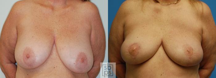 Before & After Breast Reconstruction Case 78 View #1 View in Torrance, CA