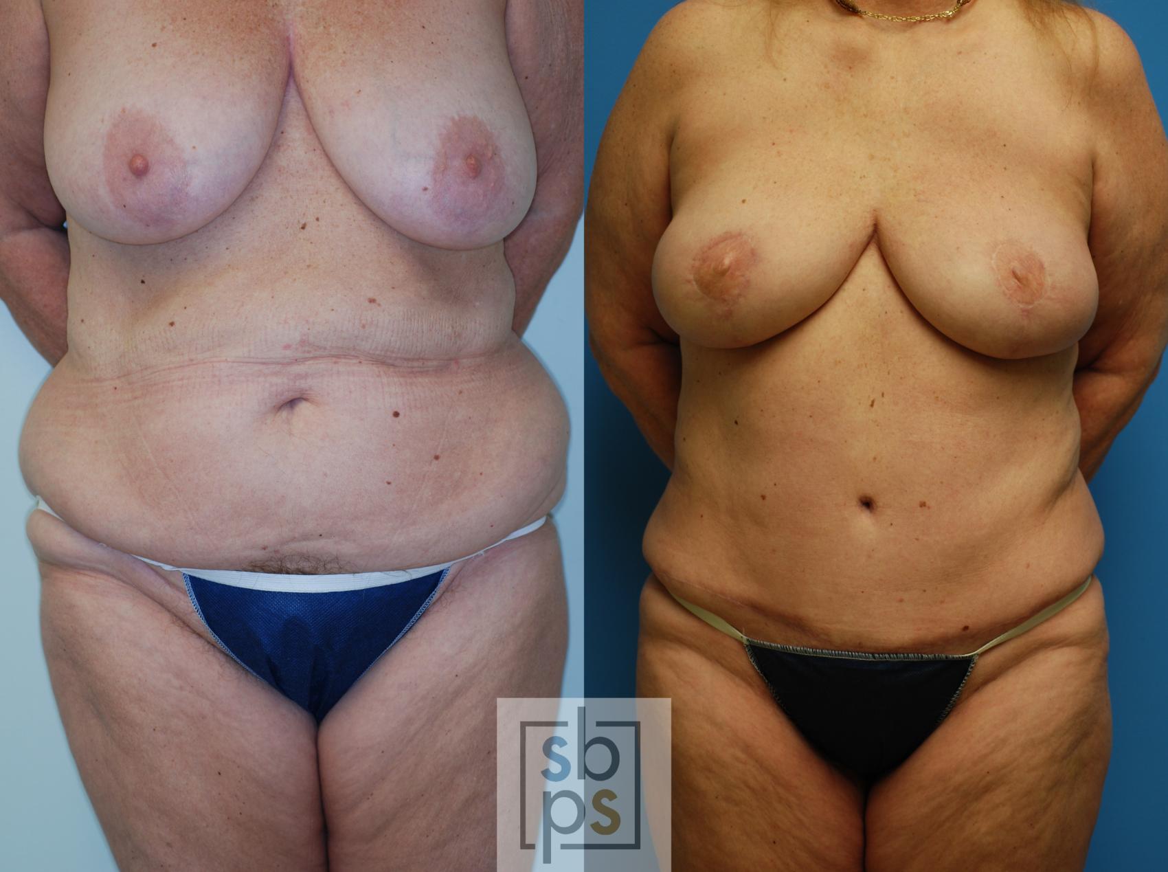 Before & After Breast Reconstruction Case 78 View #2 View in Torrance & Los Angeles, CA, CA