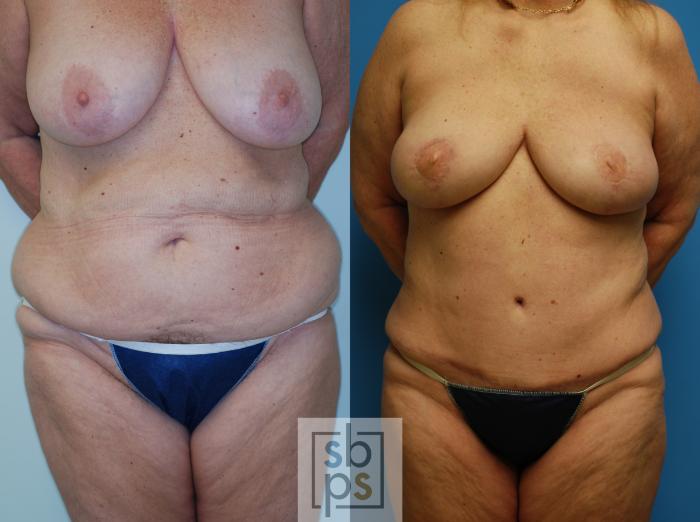Before & After Breast Reconstruction Case 78 View #2 View in Torrance, CA
