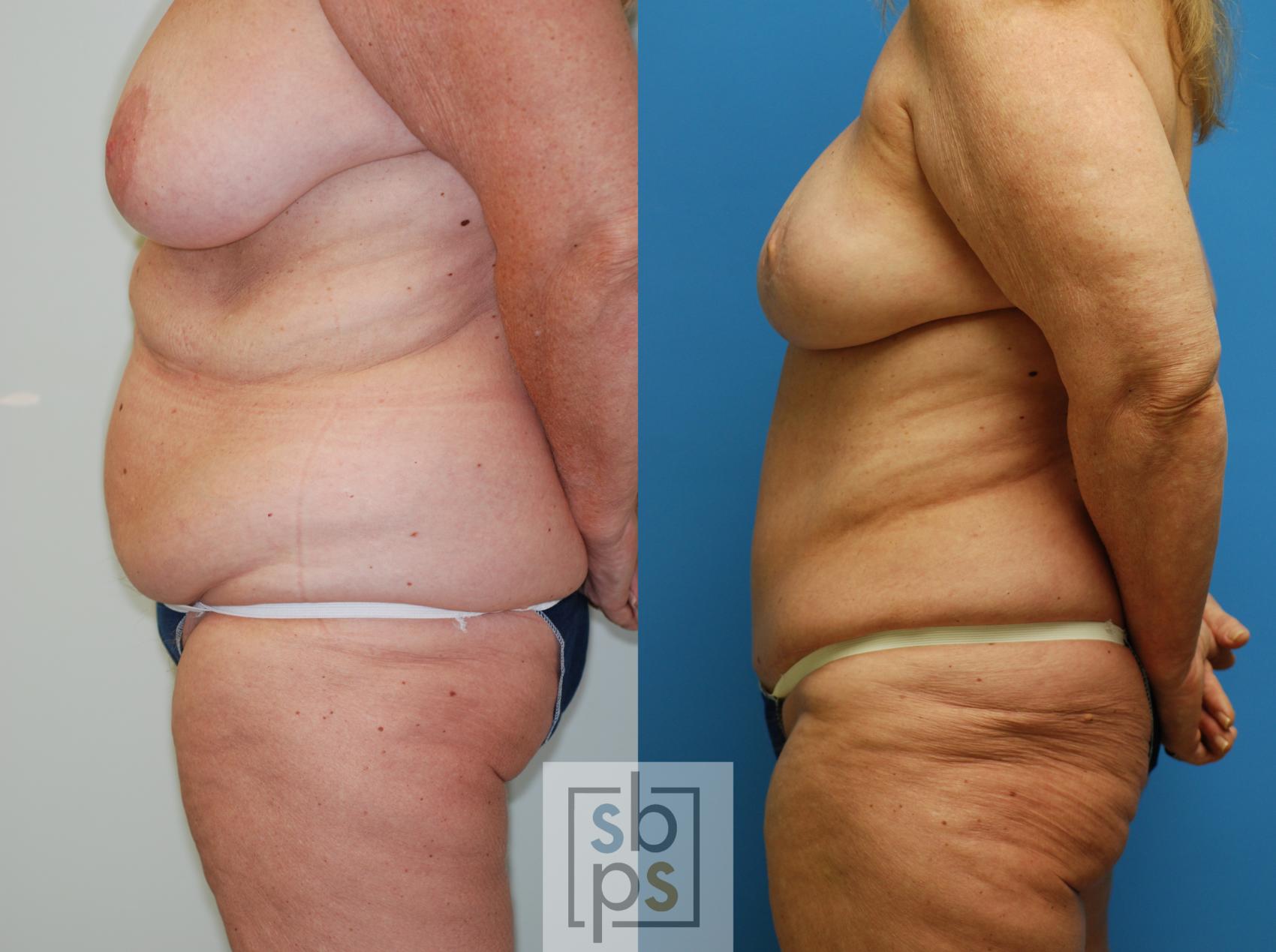 Before & After Breast Reconstruction Case 78 View #3 View in Torrance & Los Angeles, CA, CA