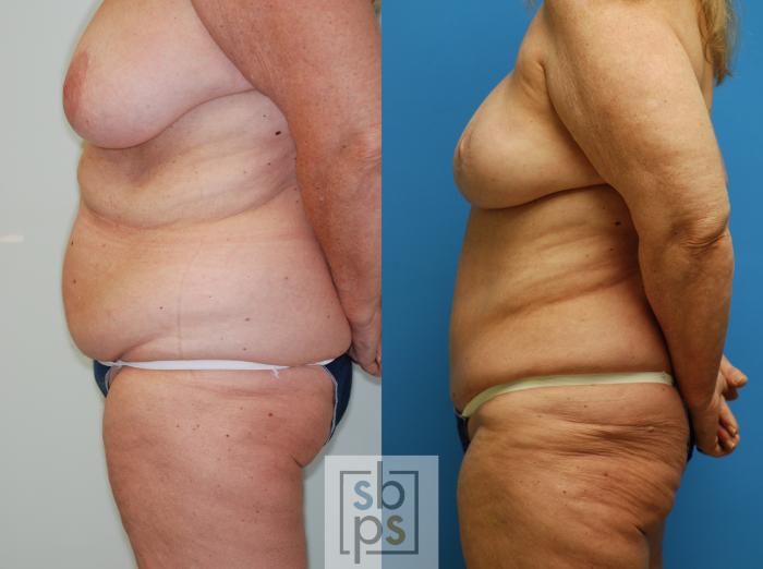 Before & After Breast Reconstruction Case 78 View #3 View in Torrance, CA