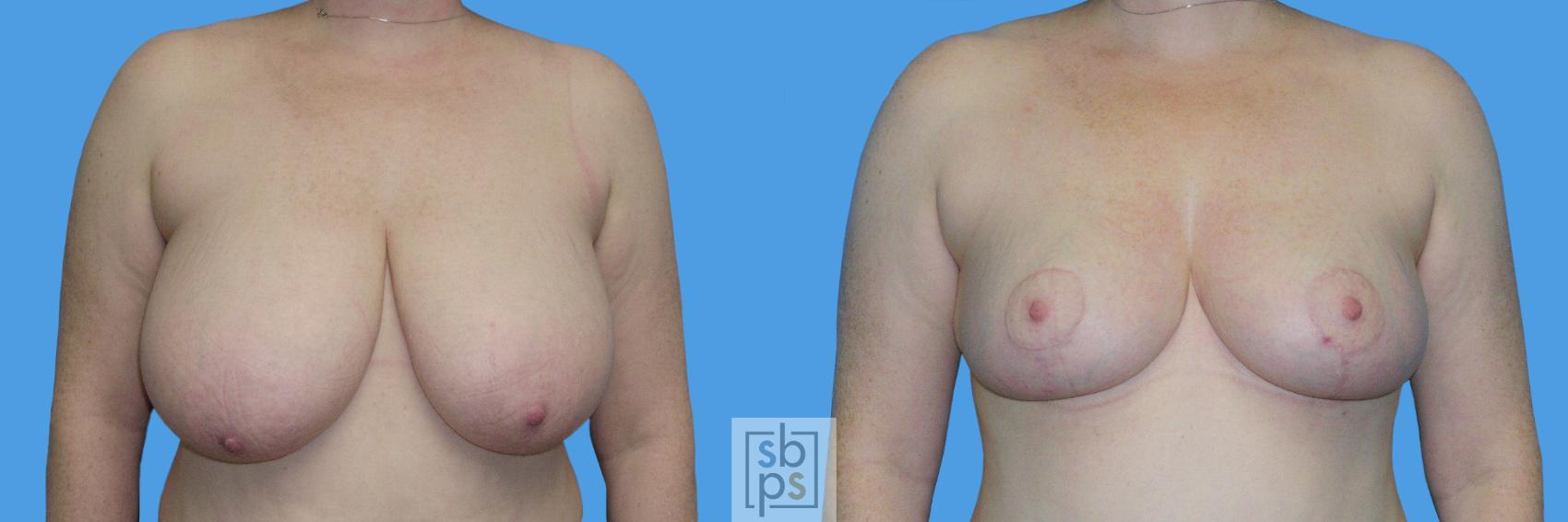 Before & After Breast Reduction Case 110 View #1 View in Torrance, CA