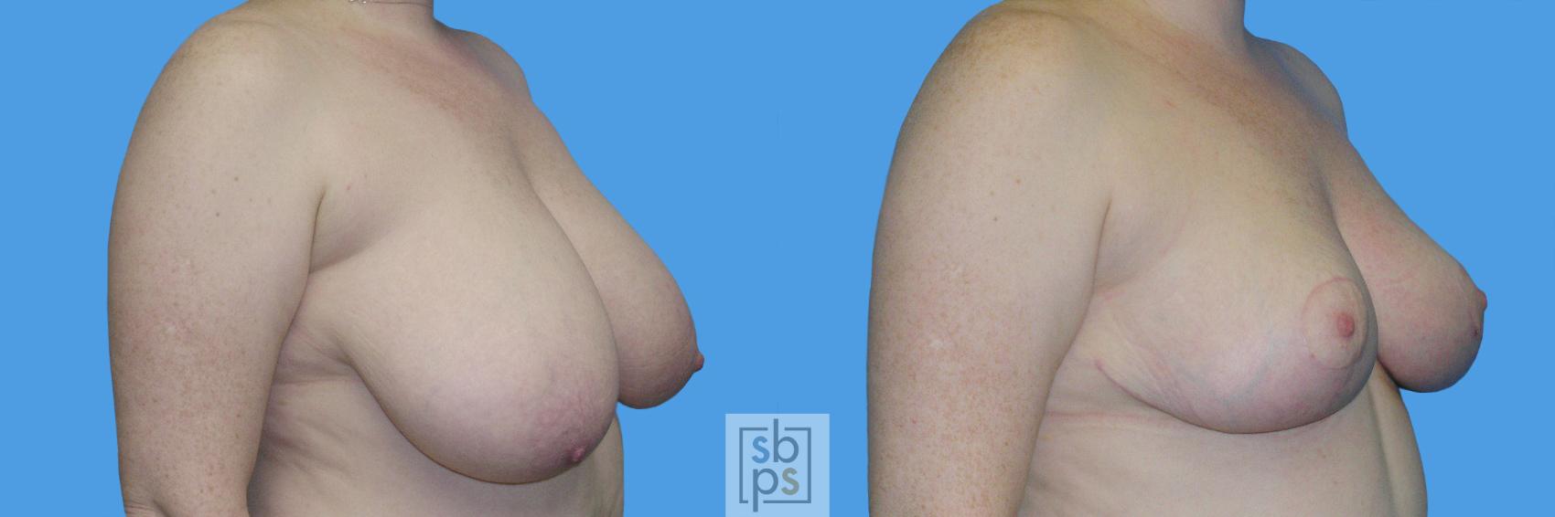 Before & After Breast Reduction Case 110 View #2 View in Torrance & Los Angeles, CA, CA
