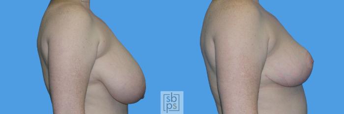 Before & After Breast Reduction Case 110 View #3 View in Torrance, CA