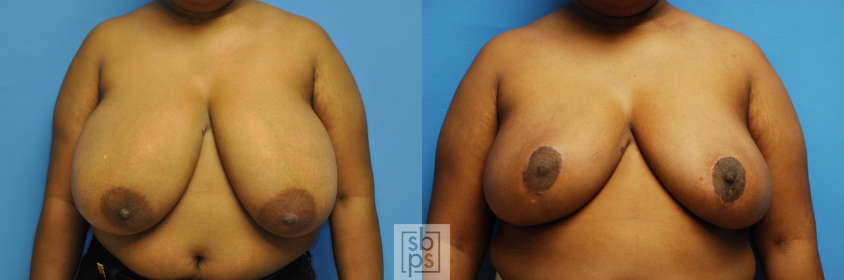 Before & After Breast Reduction Case 111 View #1 View in Torrance, CA