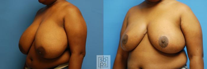 Before & After Breast Reduction Case 111 View #2 View in Torrance, CA