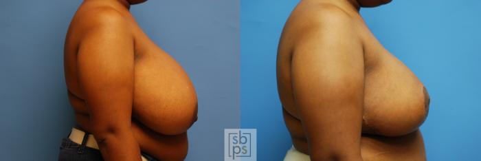 Before & After Breast Reduction Case 111 View #3 View in Torrance, CA