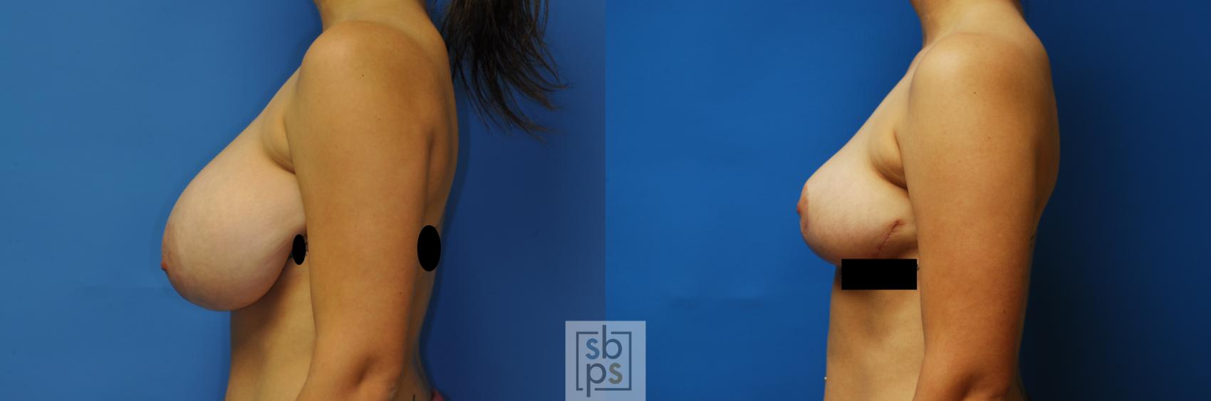 Before & After Breast Reduction Case 116 View #2 View in Torrance & Los Angeles, CA, CA