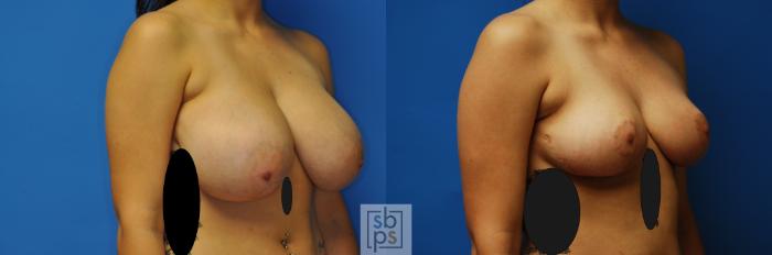 Before & After Breast Reduction Case 116 View #3 View in Torrance, CA