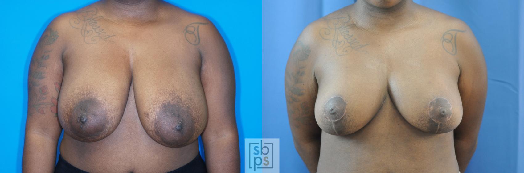 Before & After Breast Reduction Case 183 View #1 View in Torrance, CA