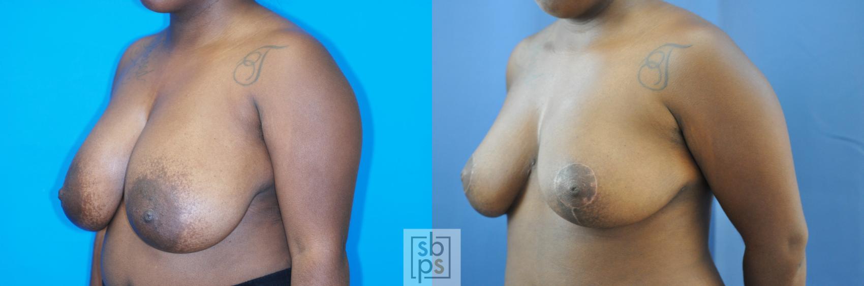 Before & After Breast Reduction Case 183 View #2 View in Torrance & Los Angeles, CA, CA