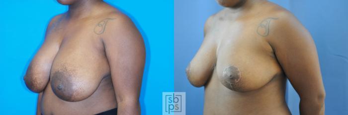 Before & After Breast Reduction Case 183 View #2 View in Torrance, CA