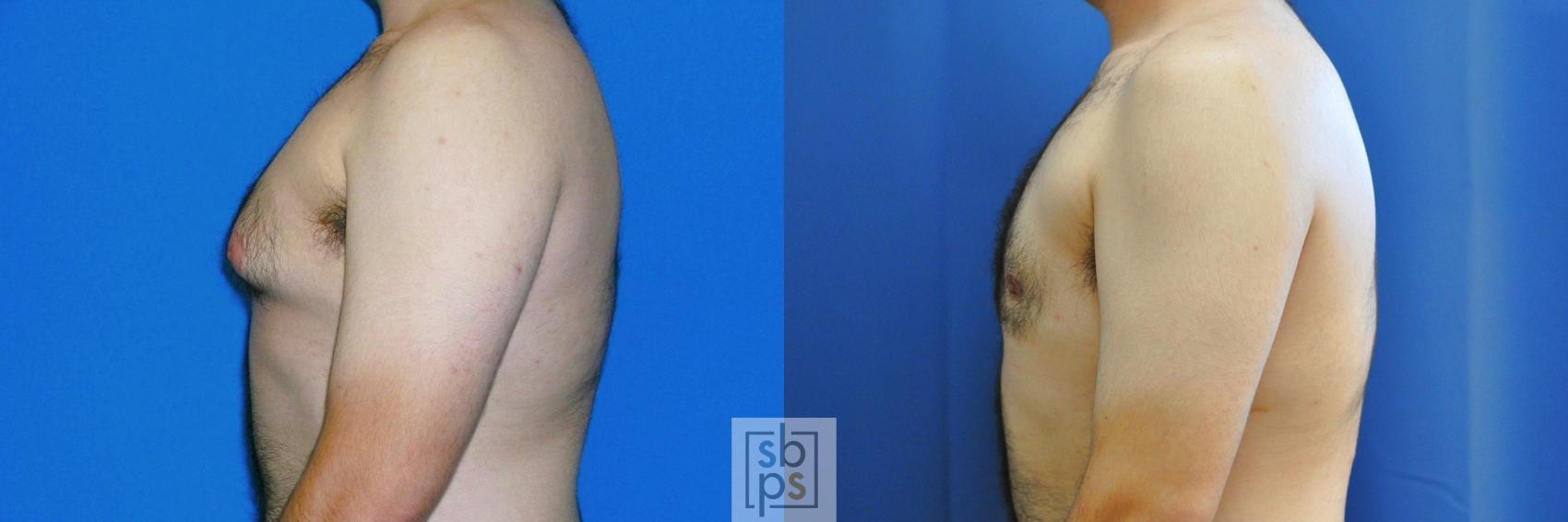 Before & After Breast Reduction Case 185 View #1 View in Torrance, CA