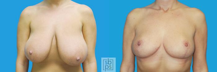 Before & After Breast Reduction Case 199 View #1 View in Torrance, CA