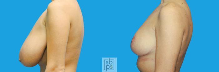 Before & After Breast Reduction Case 199 View #2 View in Torrance, CA