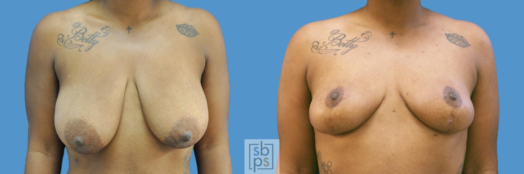 Before & After Breast Reduction Case 205 View #1 View in Torrance, CA