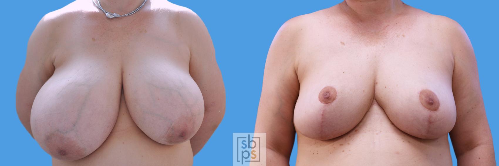 Before & After Breast Reduction Case 226 View #1 View in Torrance, CA