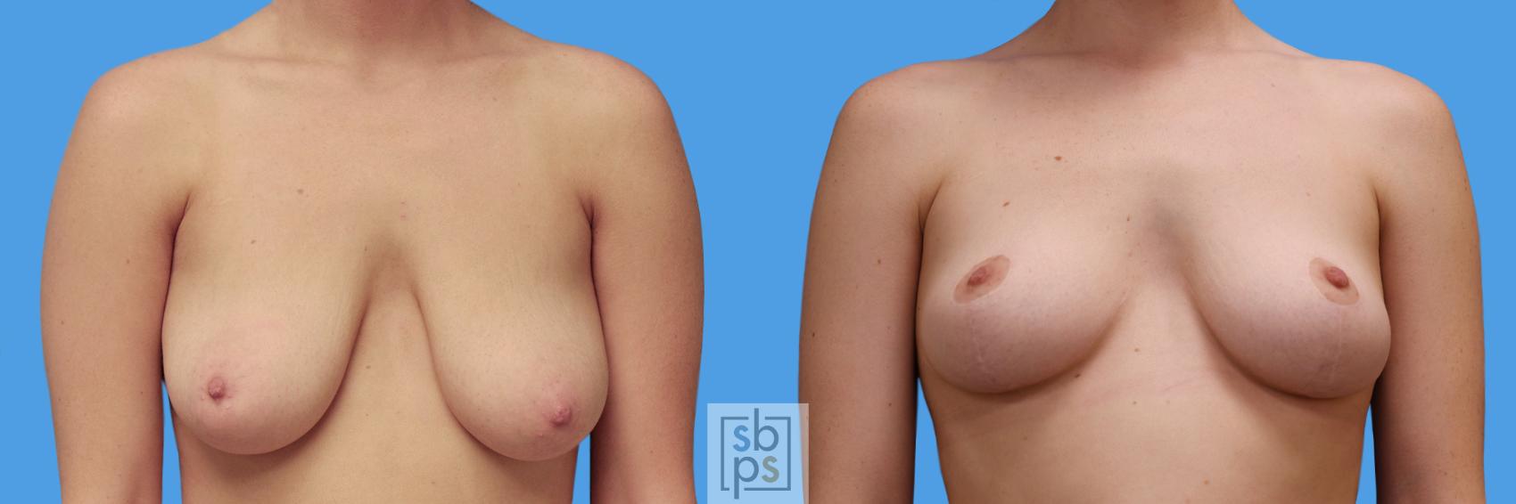 Before & After Breast Reduction Case 247 View #1 View in Torrance, CA