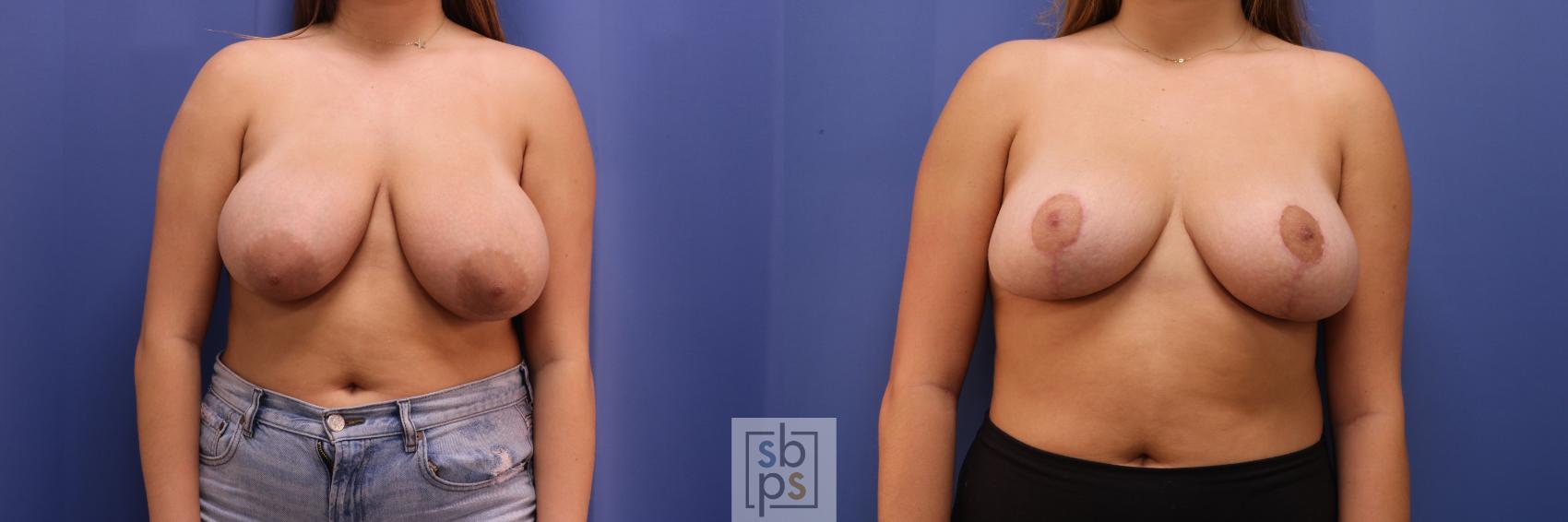 Before & After Breast Reduction Case 258 View #1 View in Torrance, CA
