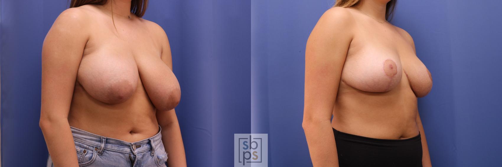 Before & After Breast Reduction Case 258 View #2 View in Torrance, CA