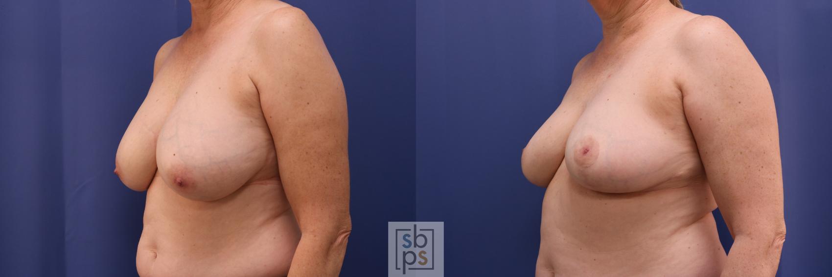 Before & After Breast Reduction Case 259 View #2 View in Torrance & Los Angeles, CA, CA