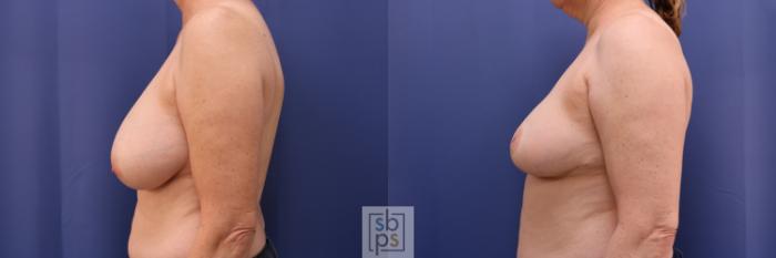 Before & After Breast Reduction Case 259 View #3 View in Torrance, CA