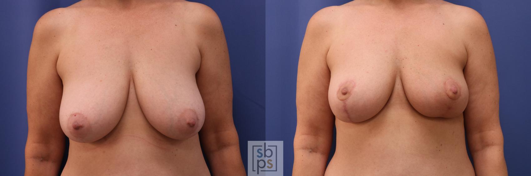 Before & After Breast Reduction Case 280 View #1 View in Torrance, CA