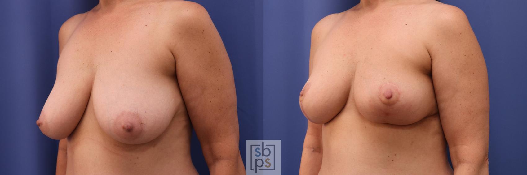 Before & After Breast Reduction Case 280 View #3 View in Torrance, CA