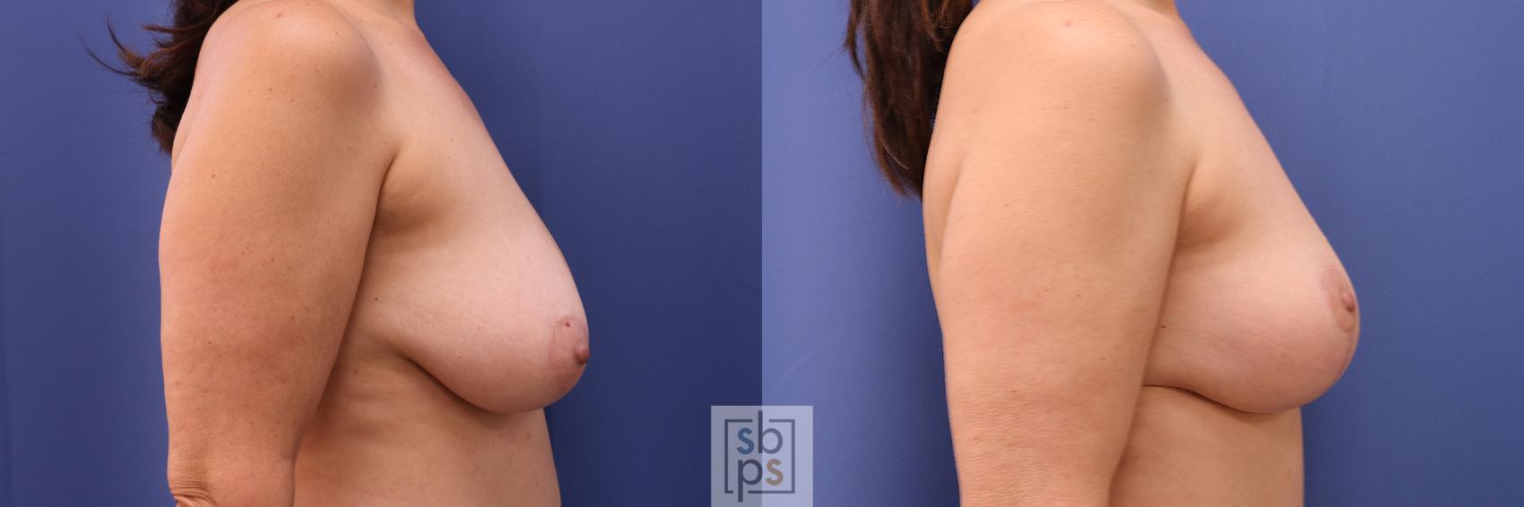 Before & After Breast Reduction Case 280 View #4 View in Torrance & Los Angeles, CA, CA