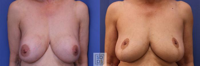 Before & After Breast Reduction Case 287 View #1 View in Torrance, CA