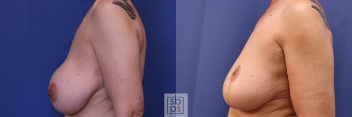 Before & After Breast Reduction Case 287 View #2 View in Torrance, CA