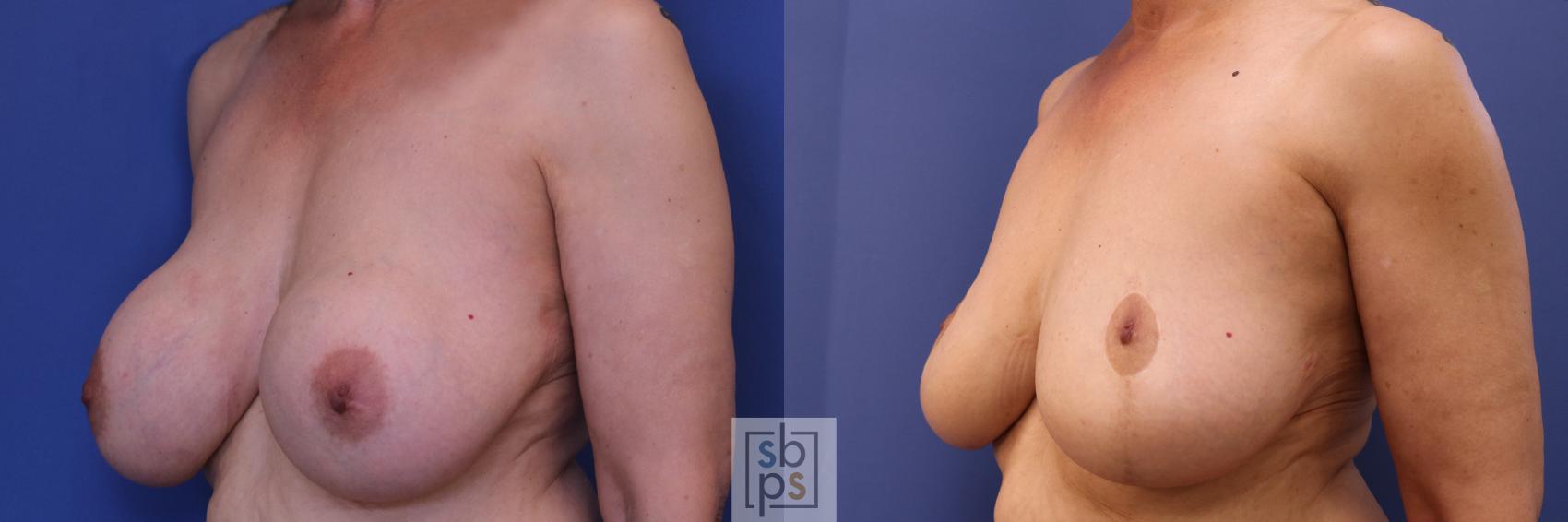 Before & After Breast Reduction Case 287 View #3 View in Torrance & Los Angeles, CA, CA