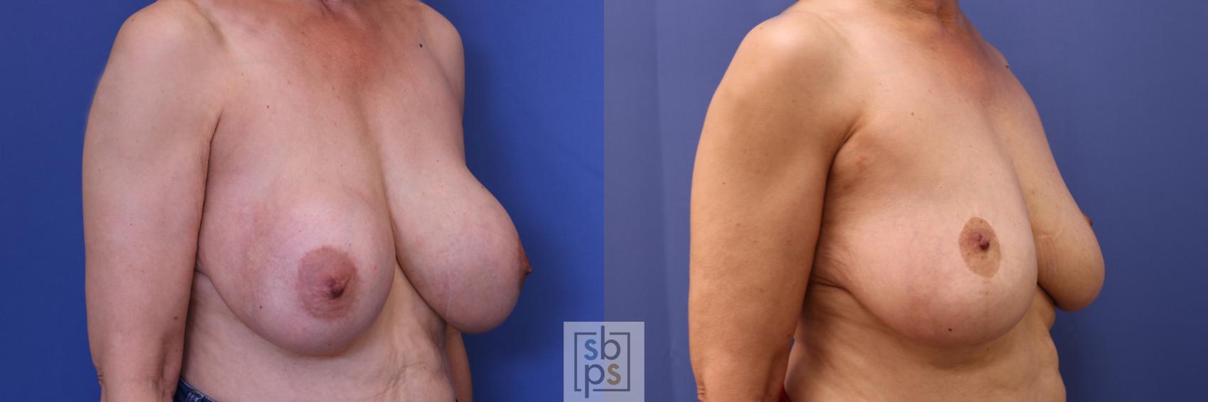 Before & After Breast Reduction Case 287 View #4 View in Torrance & Los Angeles, CA, CA