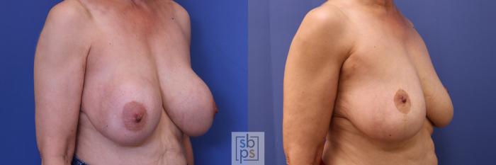 Before & After Breast Reduction Case 287 View #4 View in Torrance, CA