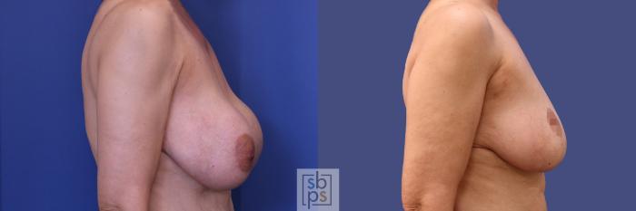 Before & After Breast Reduction Case 287 View #5 View in Torrance, CA