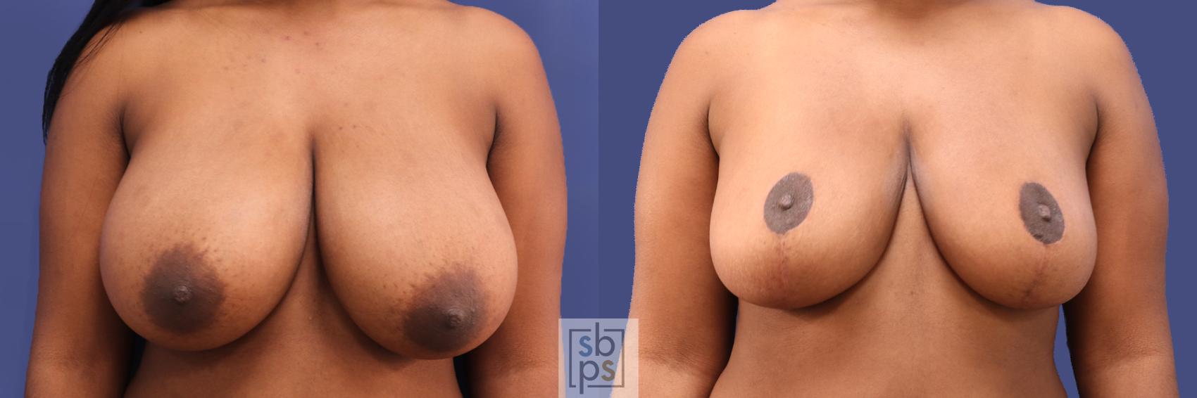 Before & After Breast Reduction Case 289 View #1 View in Torrance, CA
