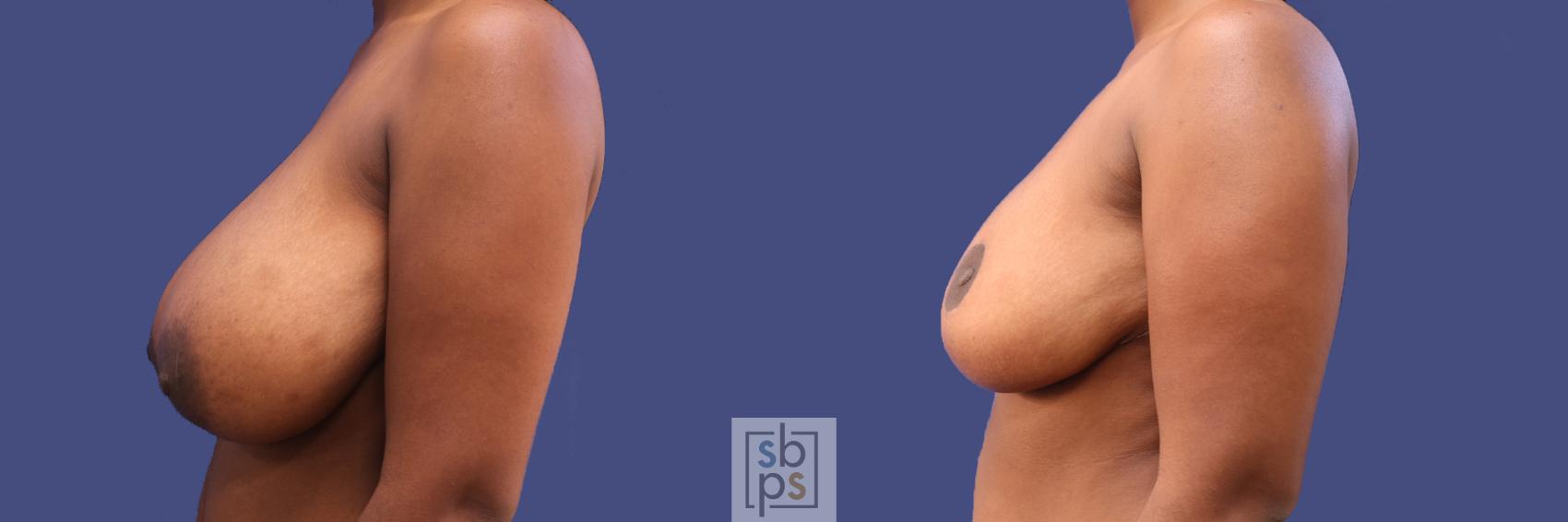 Before & After Breast Reduction Case 289 View #2 View in Torrance & Los Angeles, CA, CA