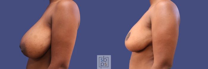 Before & After Breast Reduction Case 289 View #2 View in Torrance, CA