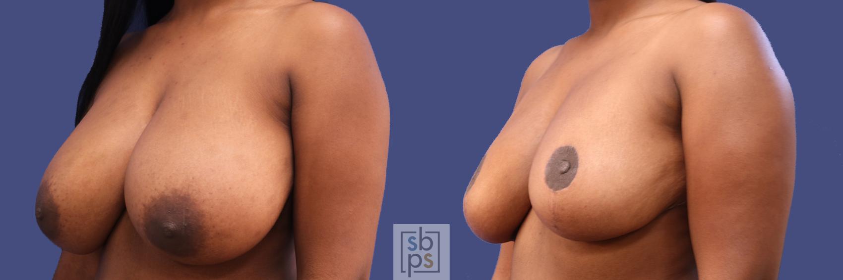 Before & After Breast Reduction Case 289 View #3 View in Torrance & Los Angeles, CA, CA