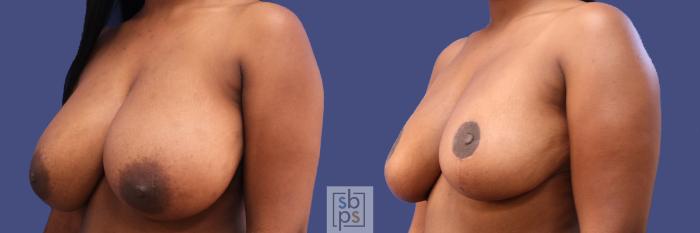 Before & After Breast Reduction Case 289 View #3 View in Torrance, CA