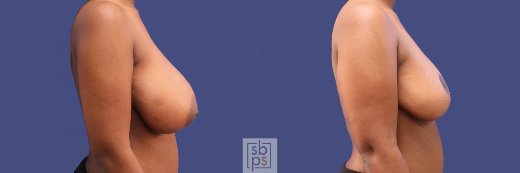 Before & After Breast Reduction Case 289 View #4 View in Torrance & Los Angeles, CA, CA