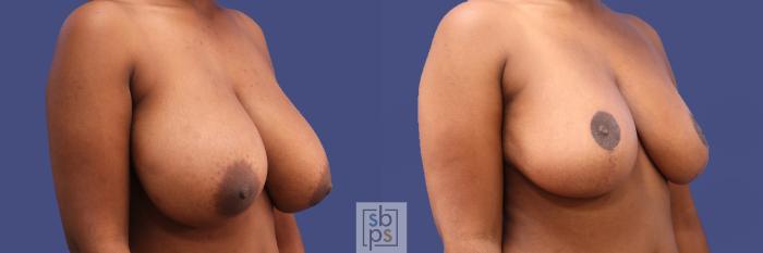 Before & After Breast Reduction Case 289 View #5 View in Torrance, CA