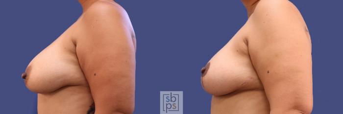 Before & After Breast Reduction Case 300 View #2 View in Torrance, CA