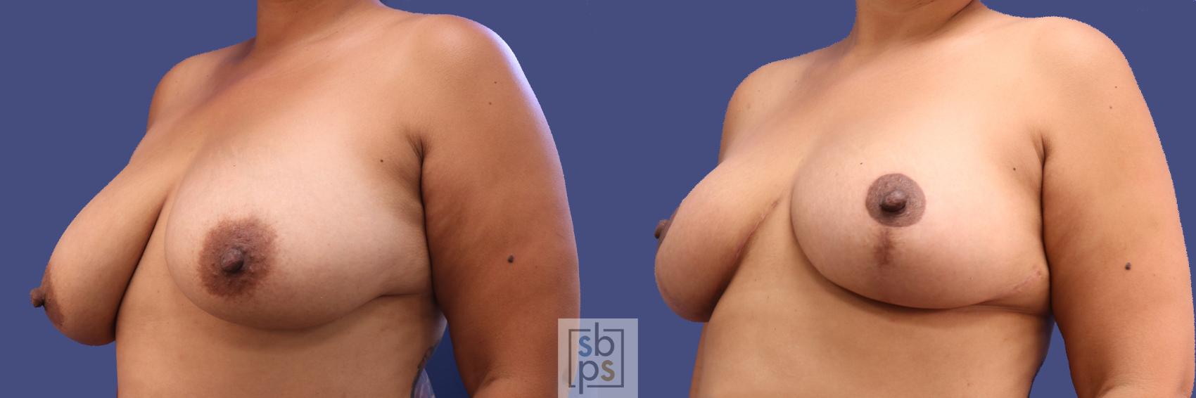 Before & After Breast Reduction Case 300 View #3 View in Torrance & Los Angeles, CA, CA