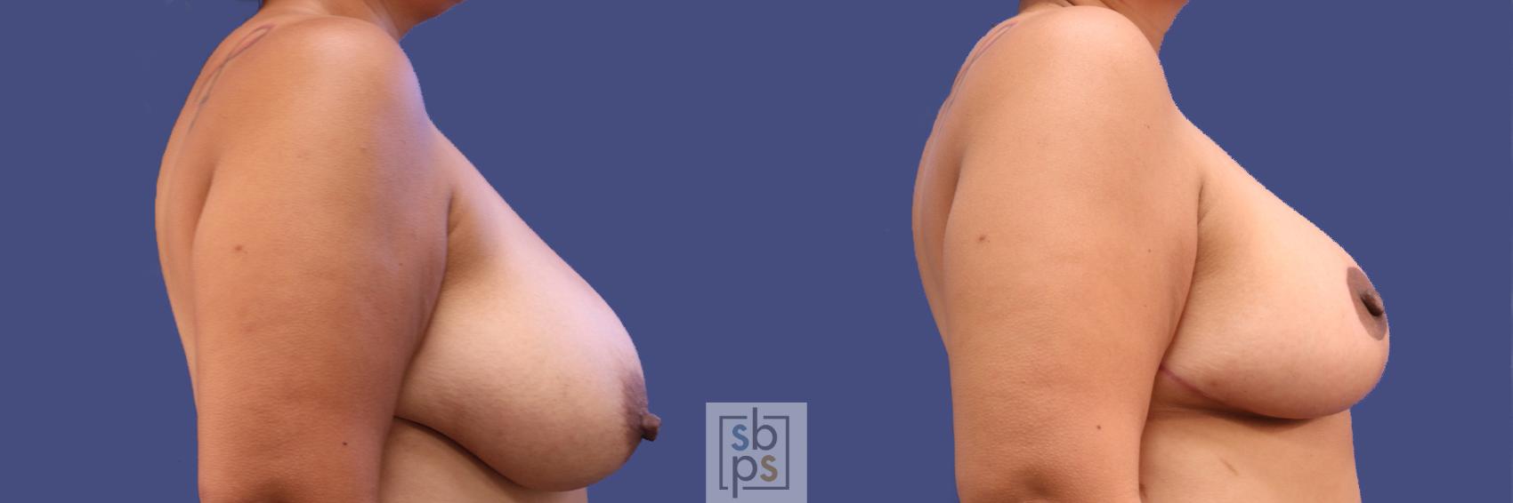 Before & After Breast Reduction Case 300 View #4 View in Torrance & Los Angeles, CA, CA