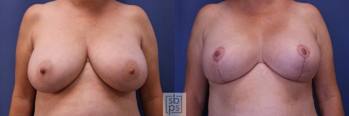 Before & After Breast Reduction Case 304 View #1 View in Torrance, CA