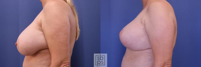 Before & After Breast Reconstruction Case 304 View #2 View in Torrance, CA